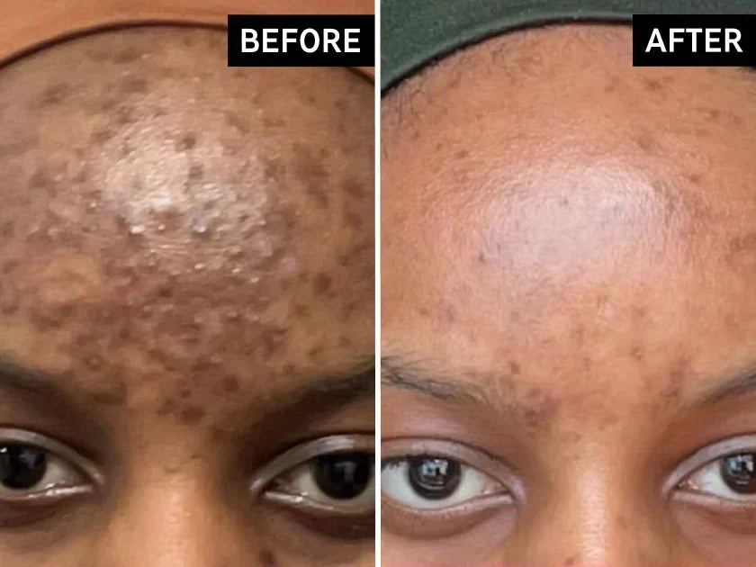 Tranexamic Acid Before and After: How Long Does It Take?