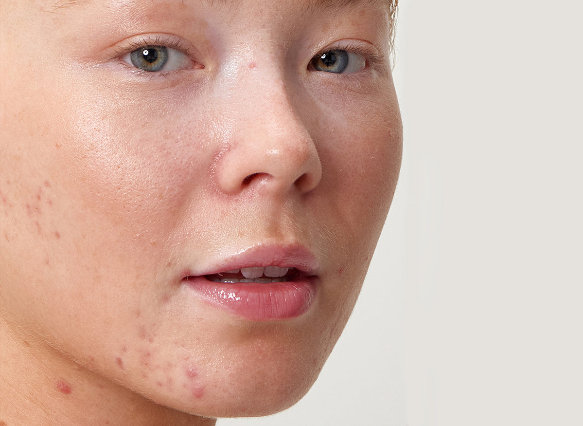 How to reduce acne scars The INKEY List