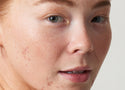 Acne 101