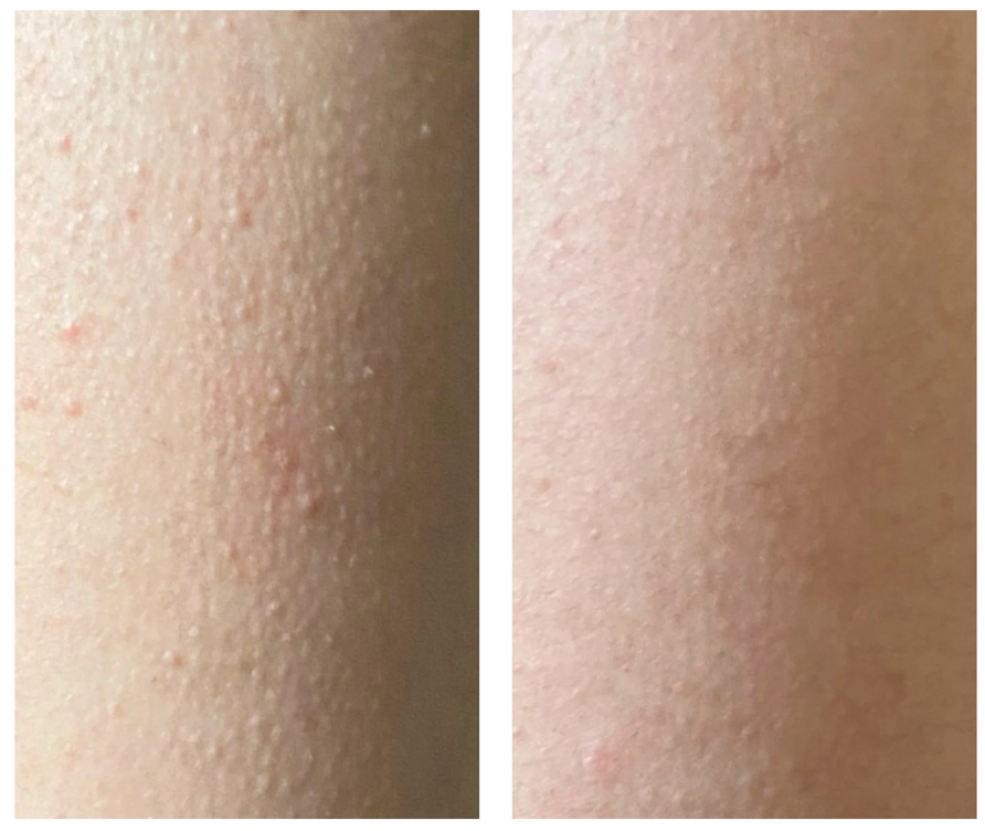 can glutathione help keratosis pilaris Chlorine Dioxide Complex Cleanser: A New Agent With Rapid Efficacy for - JDDonline Keratosis pilaris treatment: The products