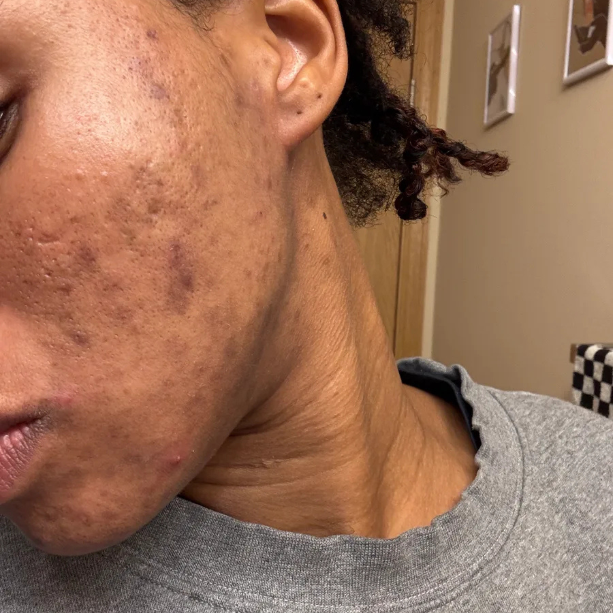 Does Diet Cause Acne? What the Research Actually Shows | INKEY