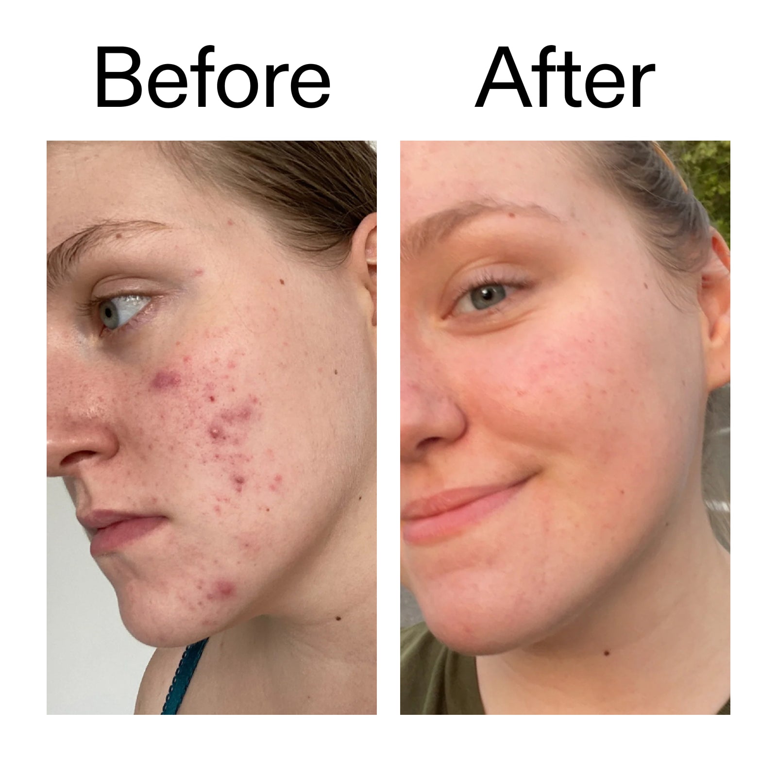 Before and after comparison of a person's face after using 15% Vitamin C + EGF Serum