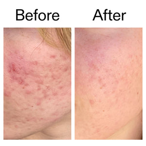 Before and after of customer using 10% Azelaic Acid Serum for Redness Relief