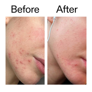Before and after comparison of skin with acne on a person's cheek.