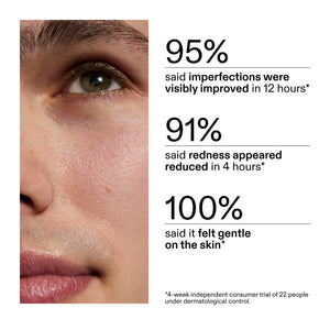 Close-up of a person's face with skincare product application, showing improvement statistics from clinical study using Succinic Acid Acne Treatment