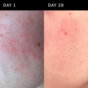 Side-by-side comparison of skin on Day 1 vs. Day 28, showing reduced redness and improved texture