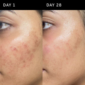 Side-by-side comparison of skin on Day 1 vs. Day 28, showing reduced redness and improved texture