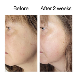 Before and after comparison of a person's face with visible acne, showing improvement after two weeks.