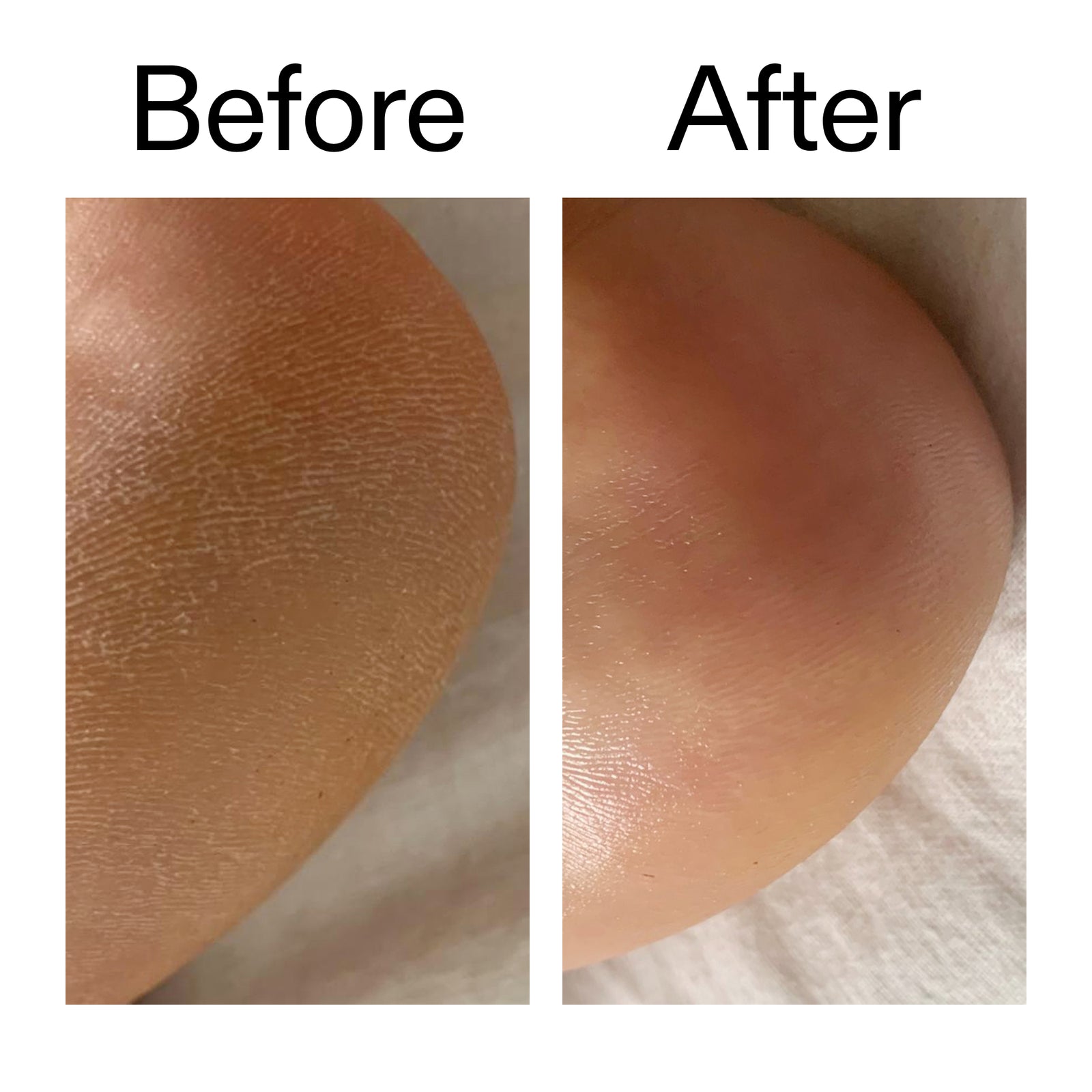 Before and after comparison of someone using Glycolic Acid Exfoliating Body Stick on their cracked heels