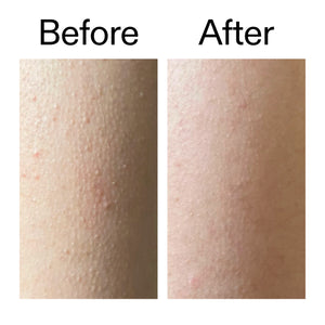 Before and after comparison of customer using Glycolic Acid Exfoliating Body Stick on their KP bumps