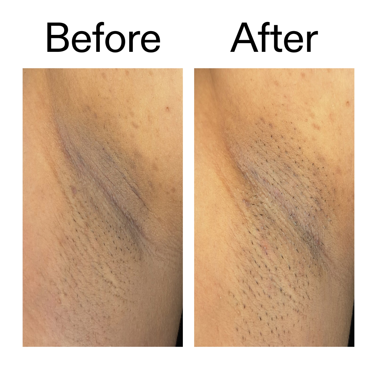 Before and after comparison someone using Glycolic Acid Exfoliating Body Sticko on their armpit