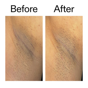 Before and after comparison someone using Glycolic Acid Exfoliating Body Sticko on their armpit
