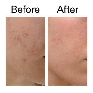 Before and after comparison of skin with acne on a white background