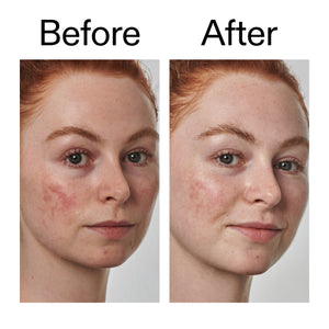 Before and after comparison of a person with acne on their face.