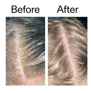 Before and after comparison of someone using Salicylic Acid Exfoliating Scalp Treatment