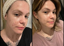 Is Glycerin Good for Oily and Acne-Prone Skin?