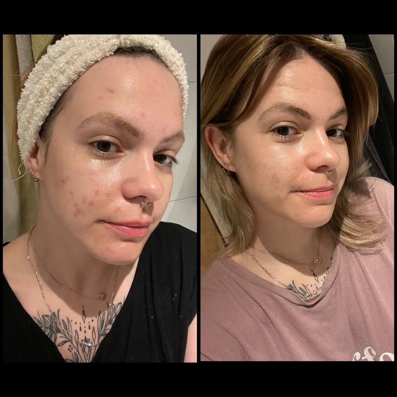 before and after of woman with acne