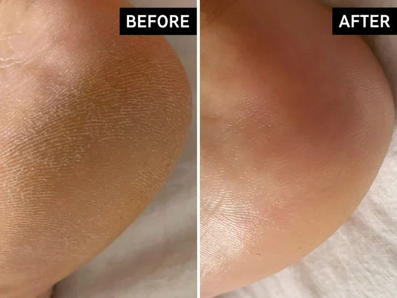 Before and after cracked heels