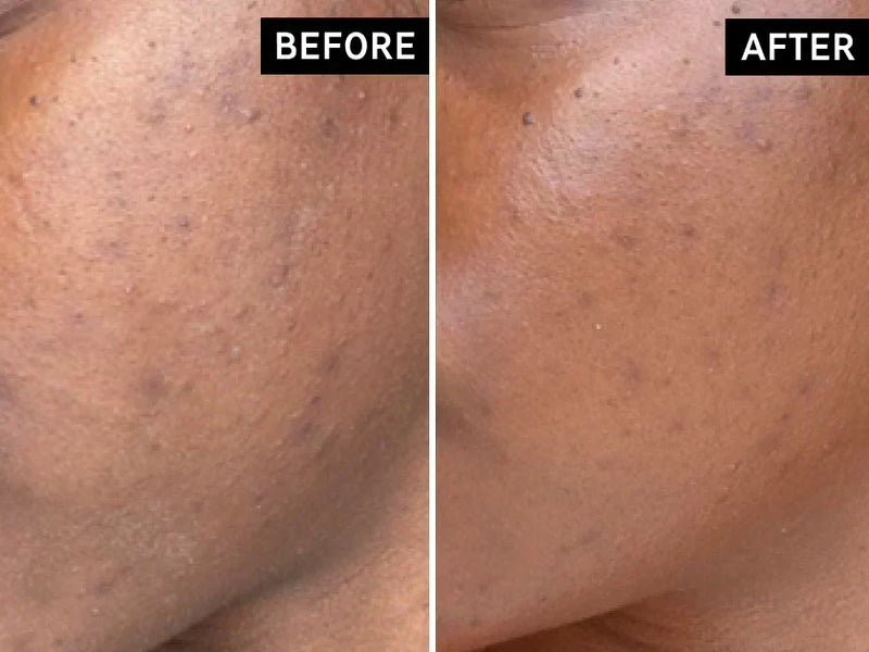 before and after of face with acne scars