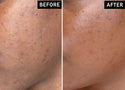 What Causes Acne Scars and How to Prevent Them