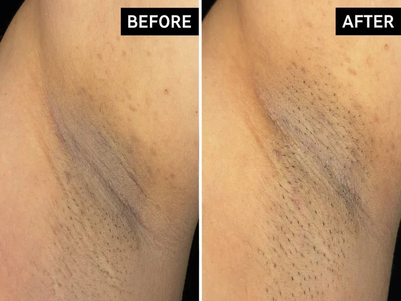 before and after discoloured armpit