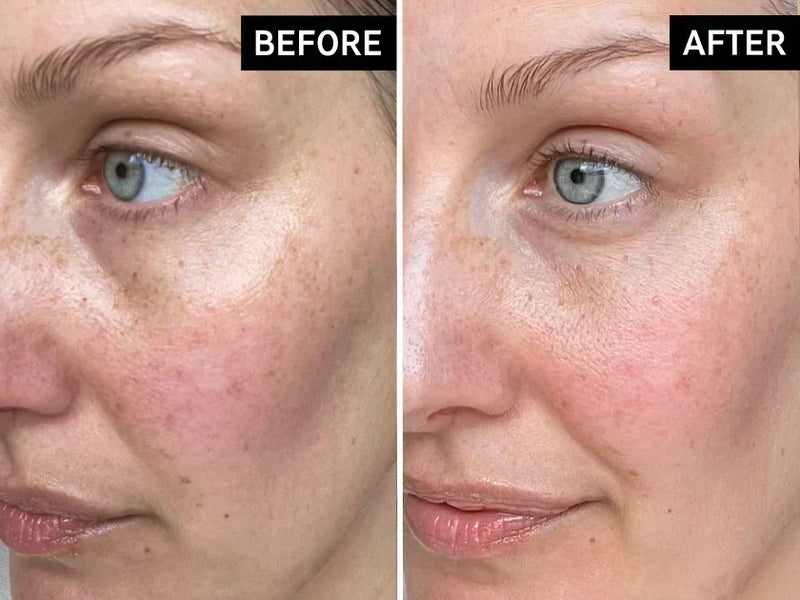 Melasma on face