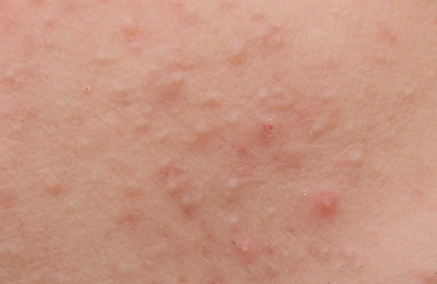 close up of fungal acne