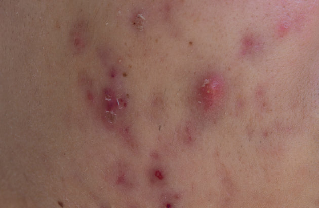 cystic acne close up