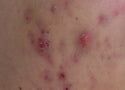 Cystic Acne: What It Is, What Causes It, and How to Treat It