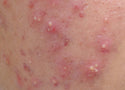 Hormonal Acne: What Causes It & How to Manage It