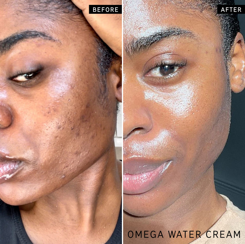 woman using omega water cream for acne