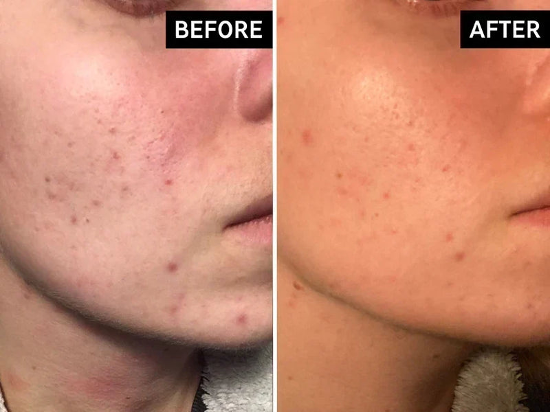before and after using glycolic acid for acne