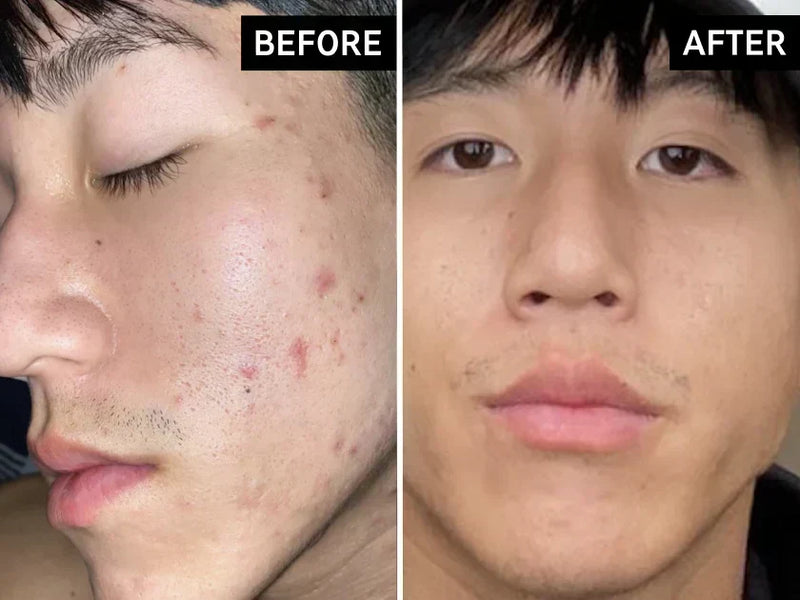 before and after using HA for acne
