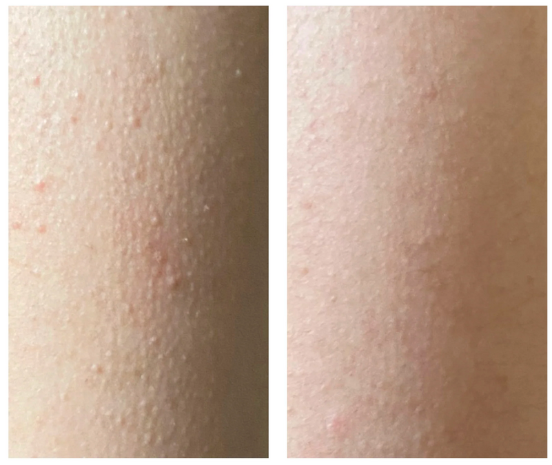 can glutathione help keratosis pilaris (KP) Treatment: How to Get Rid of Chicken Skin Anemia bpc 157 oral vs Packaging:2 L Bulk