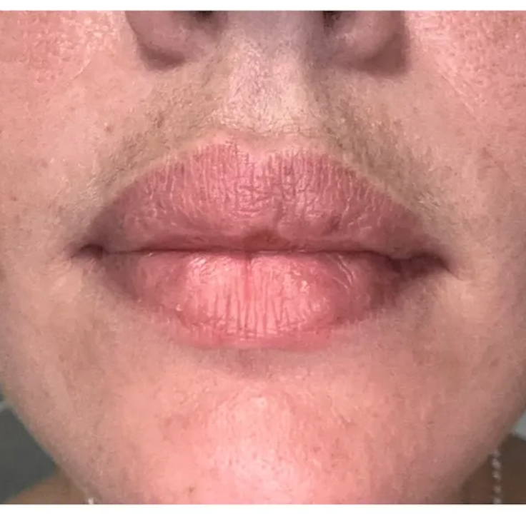 pigmentation around the mouth 