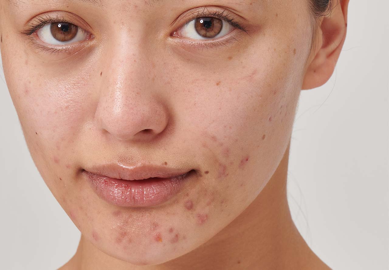 How To Care For Stressed Skin