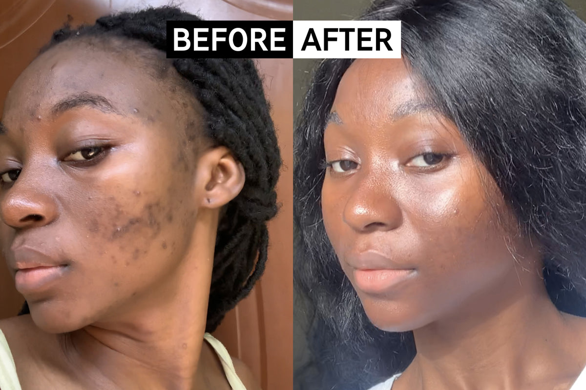 Hyperpigmentation Results Before & After With The INKEY List