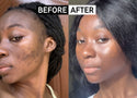 Real Results with INKEY: Scarring & Hyperpigmentation
