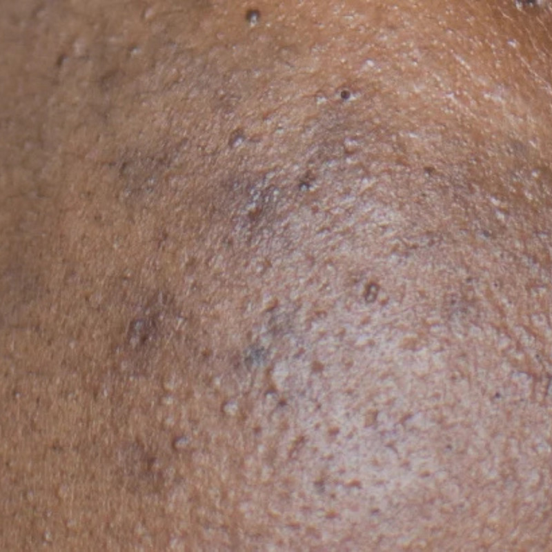 close up of hyperpigmentation and dark marks