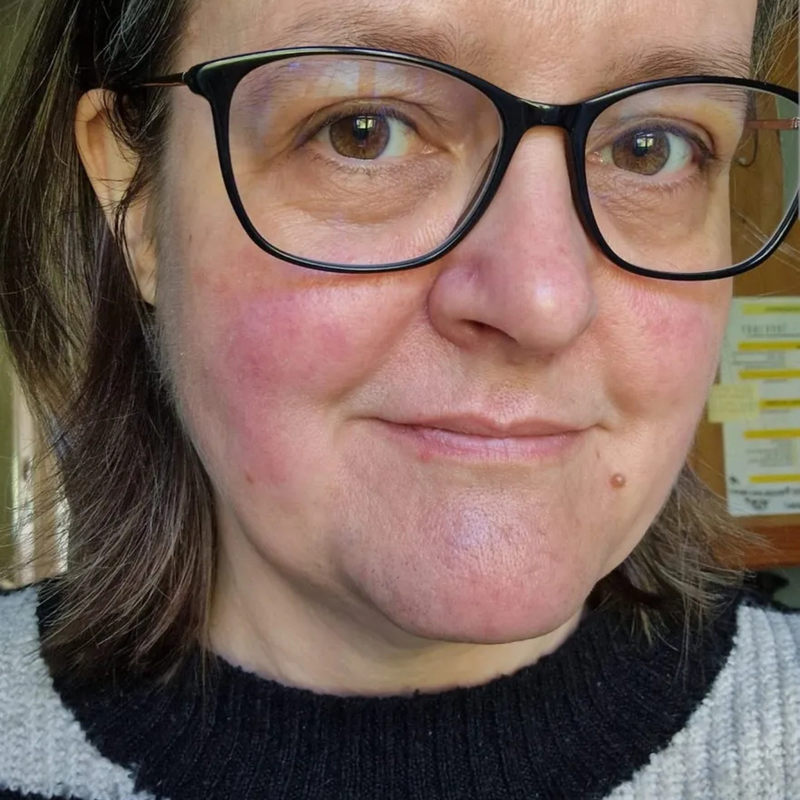 woman with redness