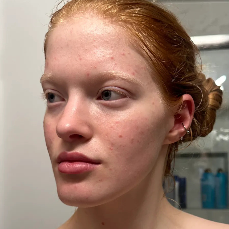 woman with acne on her face
