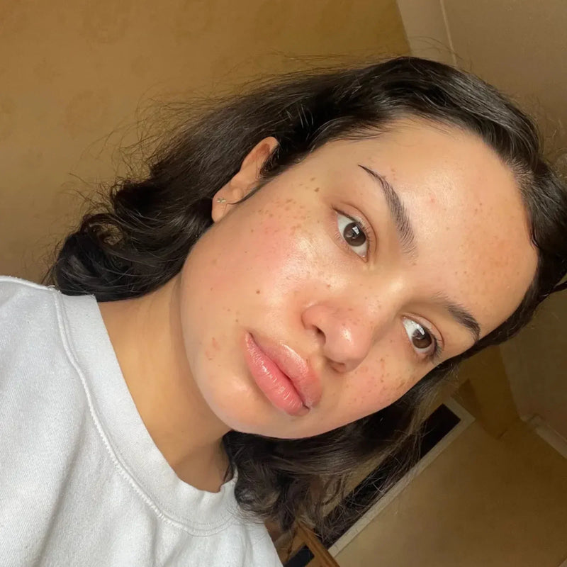 Ectoin for Rosacea-Prone Skin: The Barrier-First Approach That Actually Works