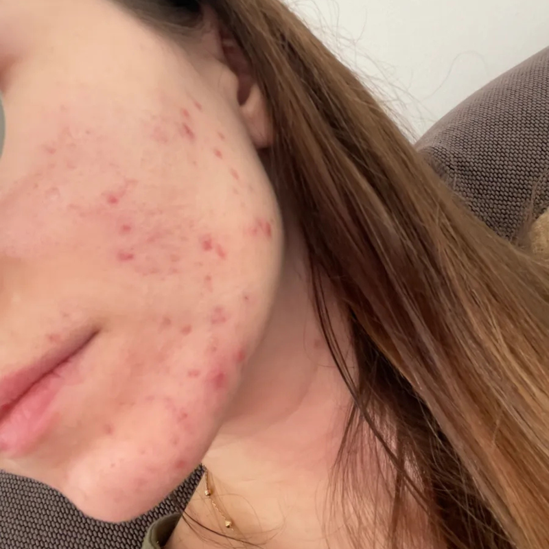 face with acne