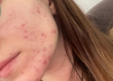 Sensitive Skin and Acne: How to Treat Without Stripping