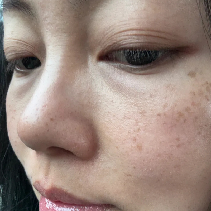 puffy eyes