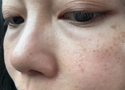 Why Are My Eyes Puffy in the Morning? Causes & Fixes