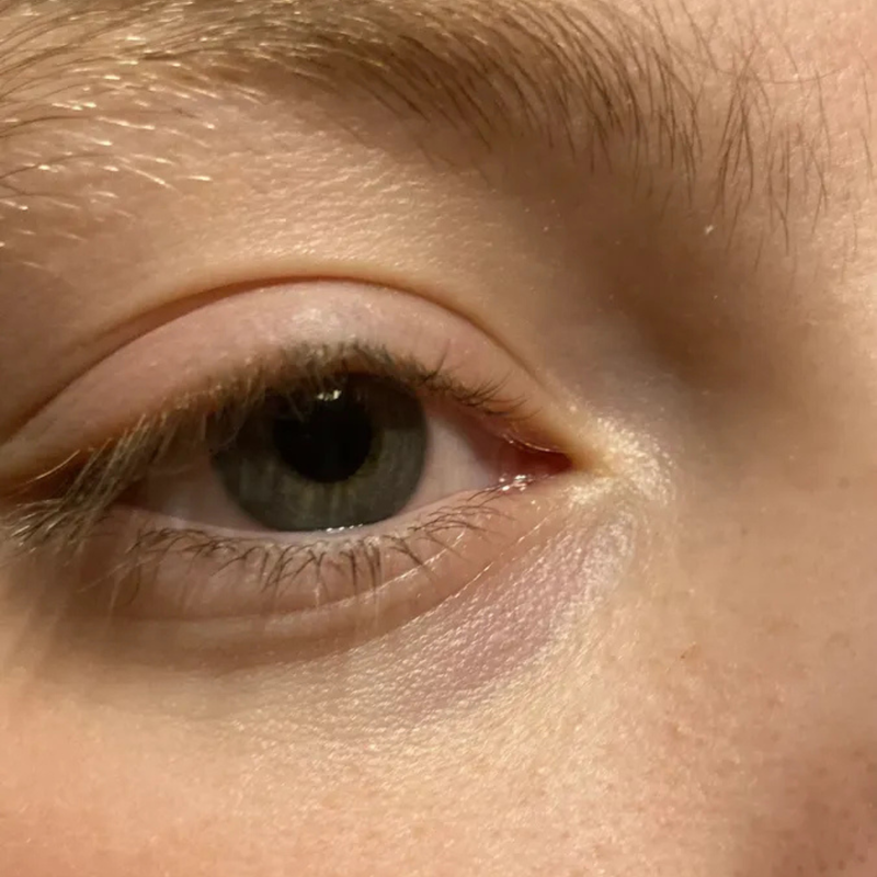 close up of sunken eyes