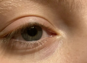 Sunken Eyes and Tear Troughs: What They Are and What You Can Do