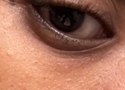 How to Get Rid of Dark Circles Under Eyes