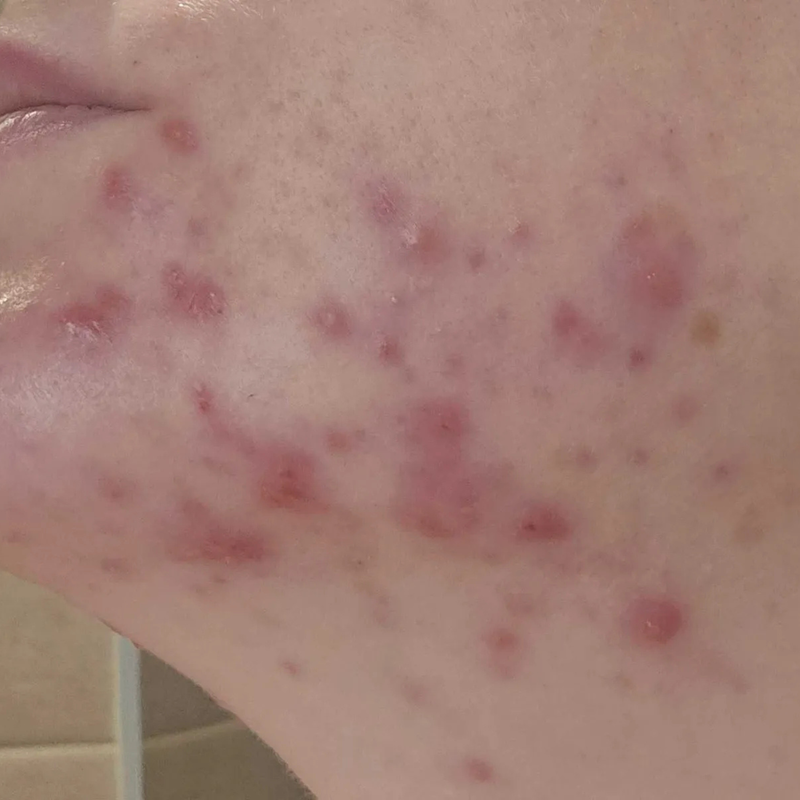 adult with acne on her chin